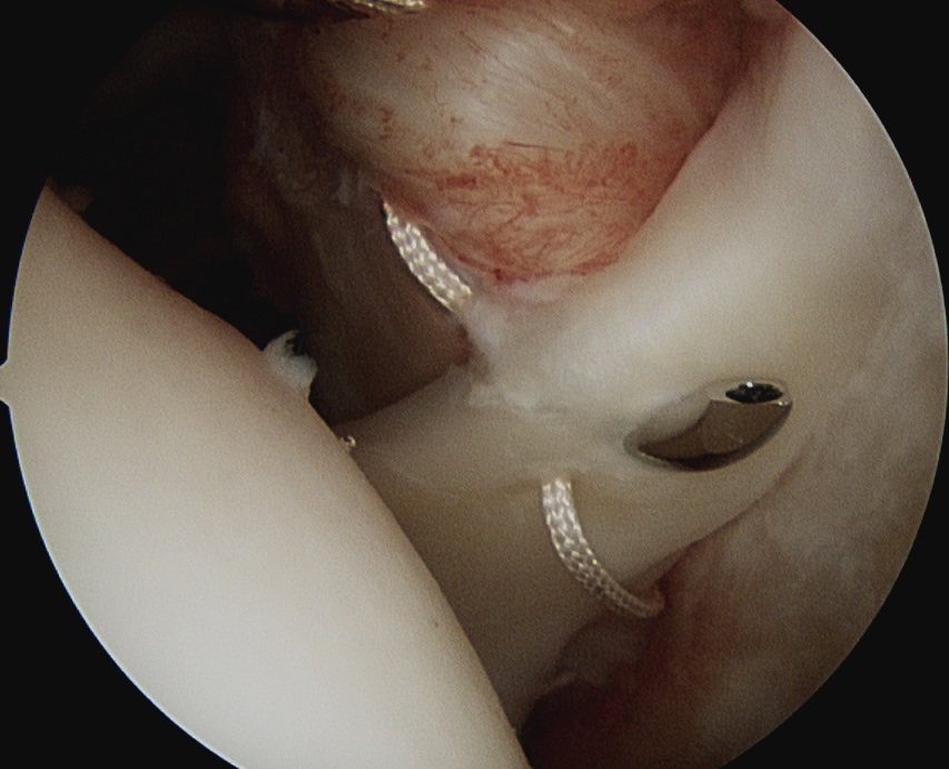 Biceps Tenodesis Second Pass